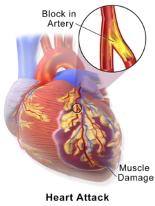 image of a heart with a blocked artery 