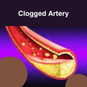 an image of clogged artery