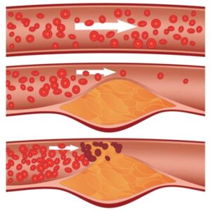 plaque in arteries